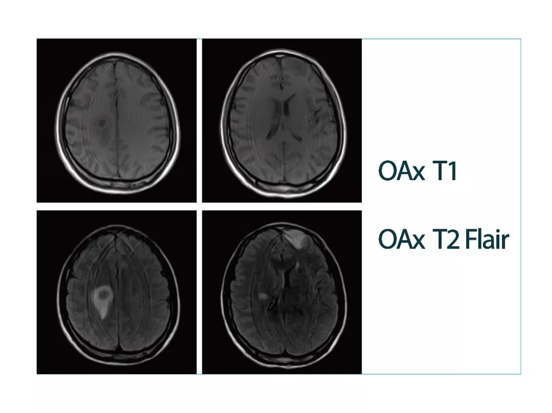 【朗润影像档案】磁共振影像病例分享（编号20180413）