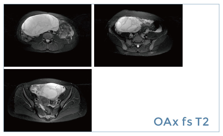 【朗润影像档案】磁共振影像病例分享（编号20190419）