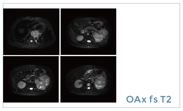 【朗润影像档案】磁共振影像病例分享(编号20190510)