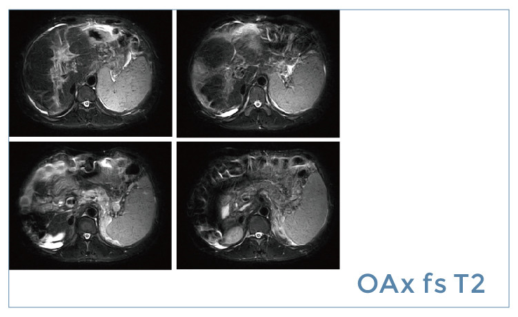 朗润影像档案】磁共振影像病例分享(编号20190517)