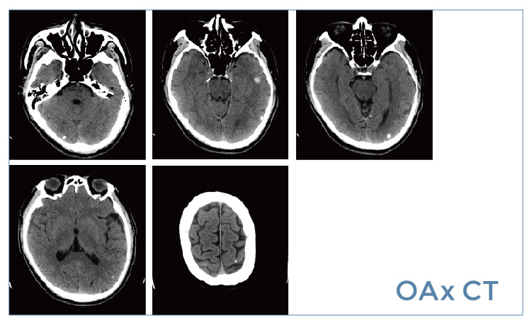 【朗润影像档案】磁共振影像病例分享(编号20190524)