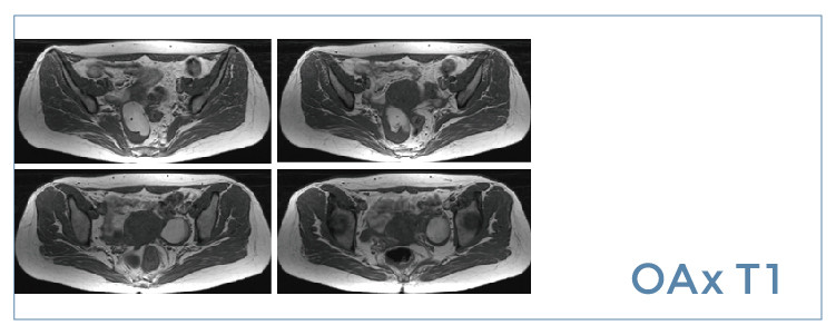 【朗润影像档案】磁共振影像病例分享(编号20190705)