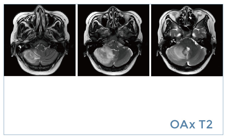 【朗润影像档案】磁共振影像病例分享(编号20190802)
