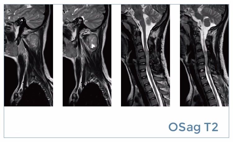 【朗润影像档案】磁共振影像病例分享(编号20190816)
