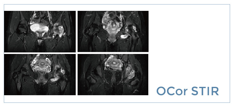【朗润影像档案】磁共振影像病例分享(编号20190809)