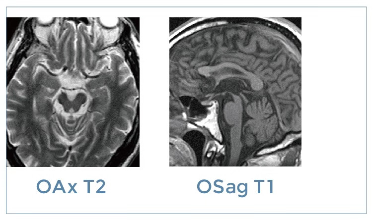 【朗润影像档案】磁共振影像病例分享(编号20191115)