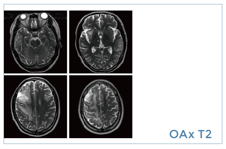 【朗润影像档案】磁共振影像病例分享(编号20191129)