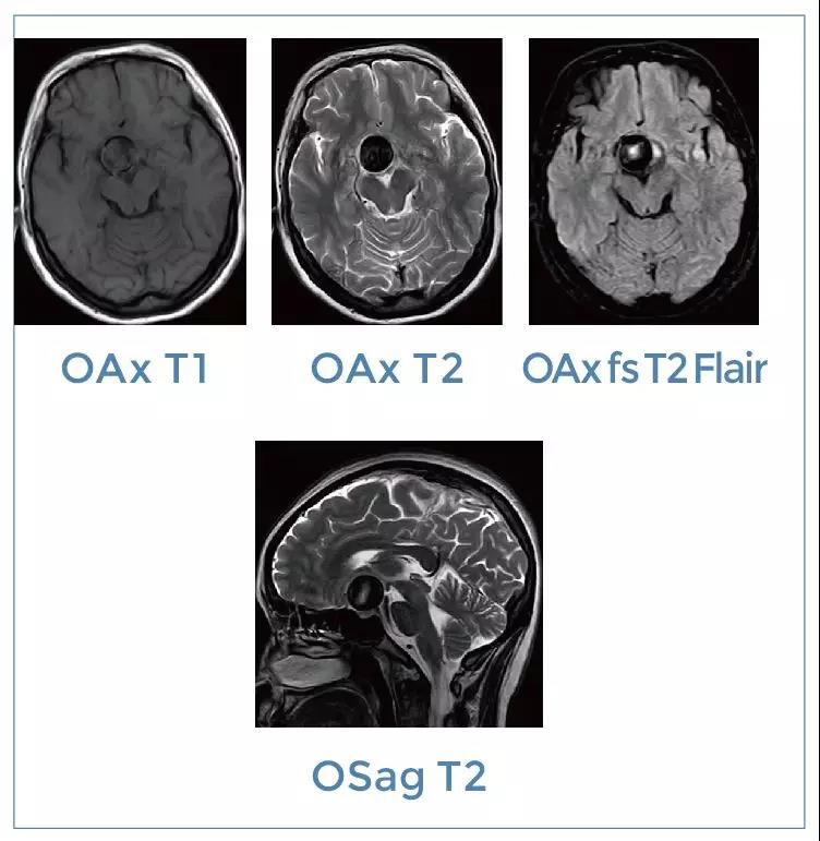 【朗润影像档案】磁共振影像病例分享(编号20200104)