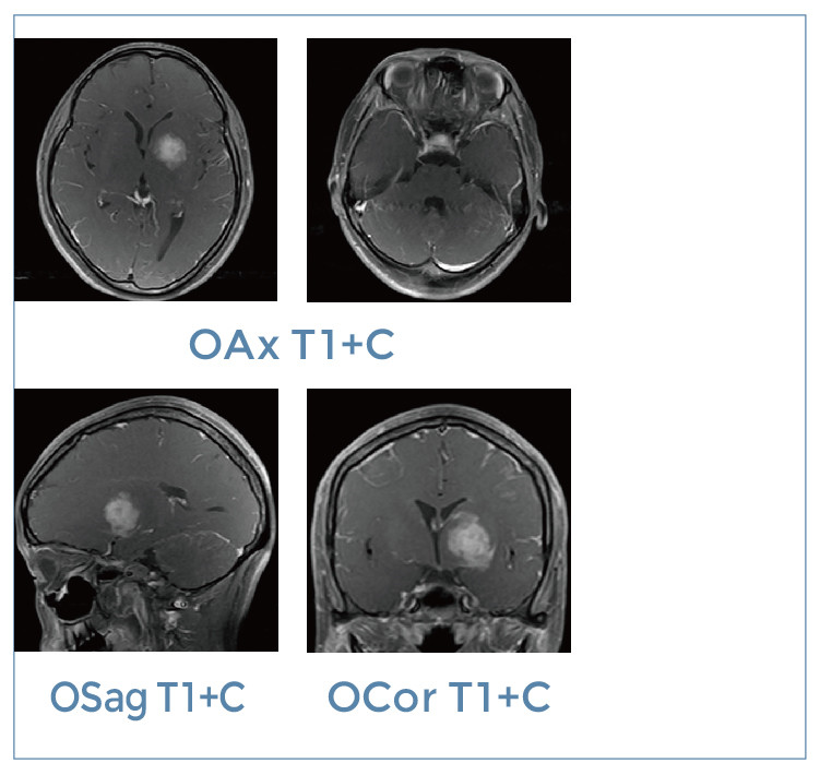 【朗润影像档案】磁共振影像病例分享(编号20200228)