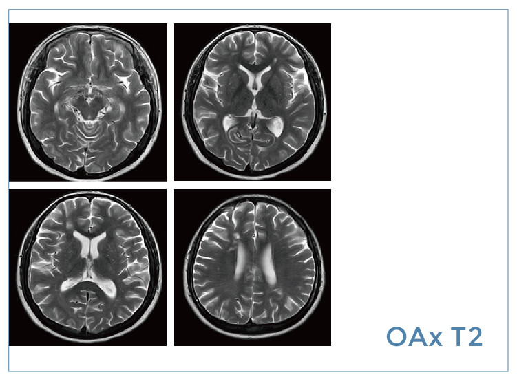 【朗润影像档案】磁共振影像病例分享(编号20200313)