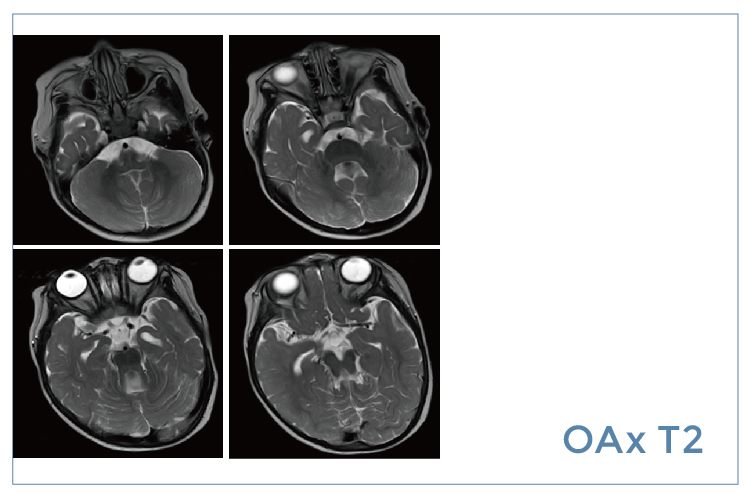 【朗润影像档案】磁共振影像病例分享(编号20200327)